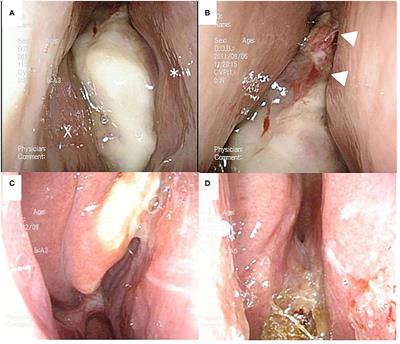 Case Report: Response to Intra-arterial Cisplatin and Concurrent Radiotherapy Followed by Salvage Surgery in a Patient With Advanced Primary Sinonasal Low-Grade Non-intestinal Adenocarcinoma